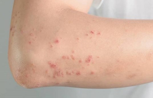 O que é Dermatite atópica?