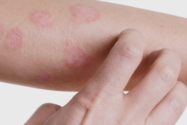 O que é Dermatite de contato?