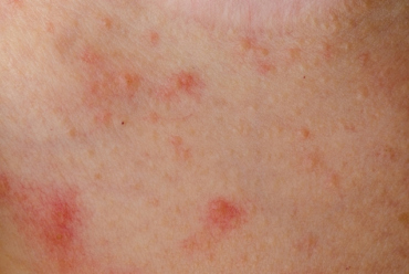 Dicas para auxiliar no tratamento da dermatite atópica