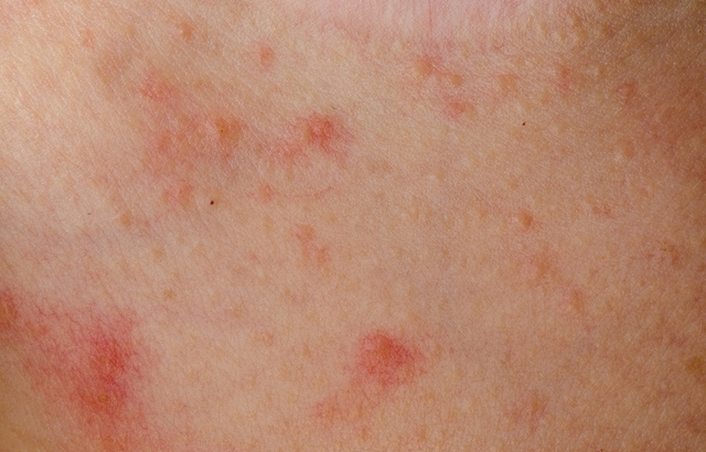 Dicas para auxiliar no tratamento da dermatite atópica